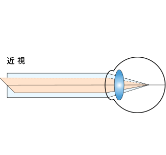 近視