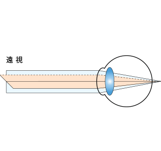 遠視