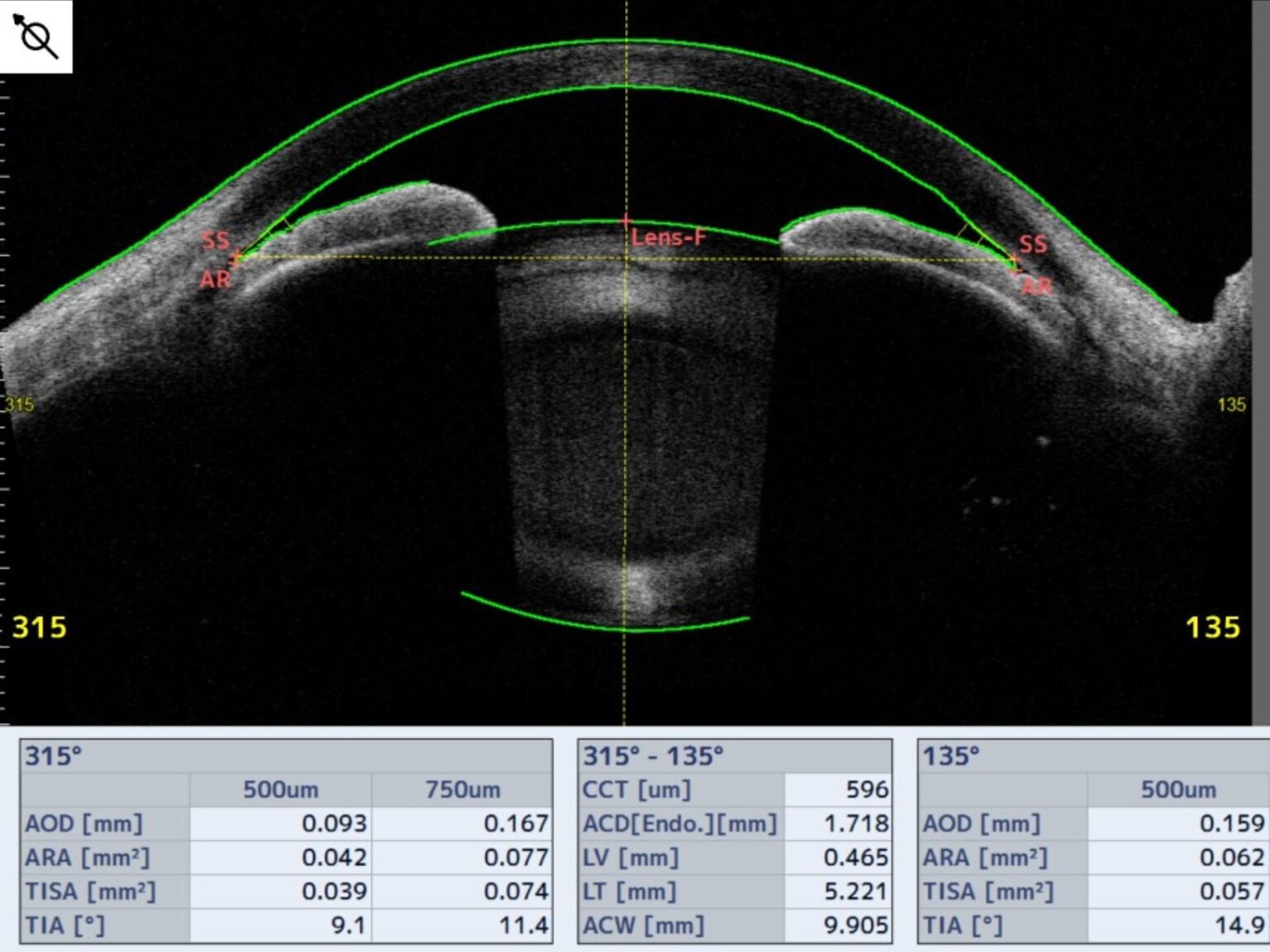 閉塞隅角緑内障の診断