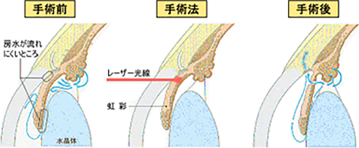 角 隅 緑内障 閉塞 急性